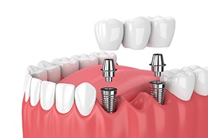 diagram of implant bridge showing abutments