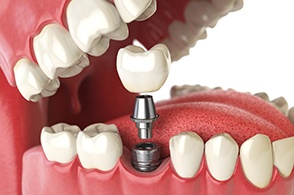 closeup diagram of a single implant abutment and restoration