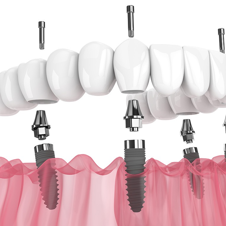 3D graphic of all on 4 implants