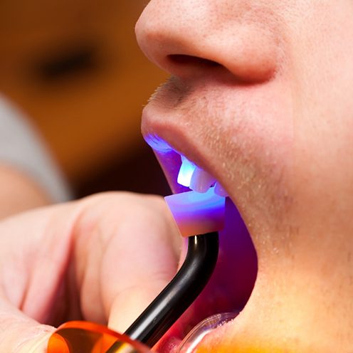 A dentist performing direct bonding on a patient