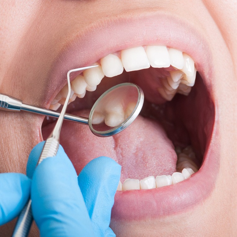 Dentist using dental tools to examine patient's teeth