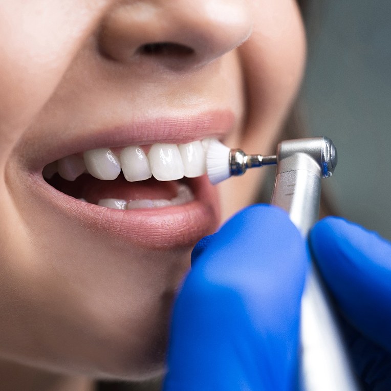 Patient smiling during polishing at dental cleaning