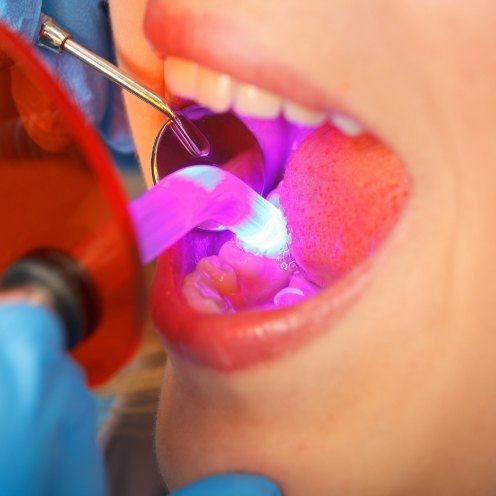 Close up of patient having their teeth fixed with direct bonding