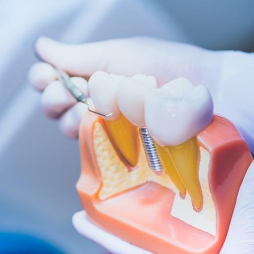 Dentist holding a model of the lower jaw with a dental implant