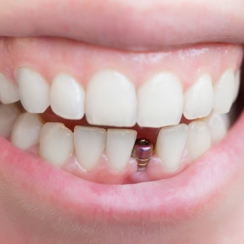 Close up of smile with visible dental implant abutment in lower arch of teeth