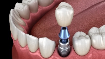 Animated dental crown being placed over dental implant