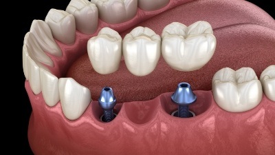 Animated dental bridge being placed over two dental implants