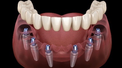 Animated full denture being placed over six dental implants