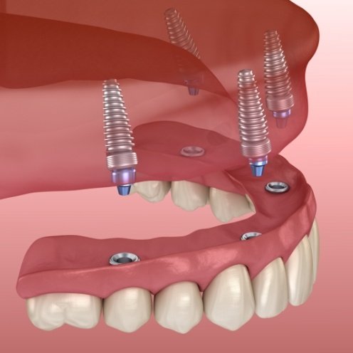 Animated All on 4 implant denture being placed in the upper arch