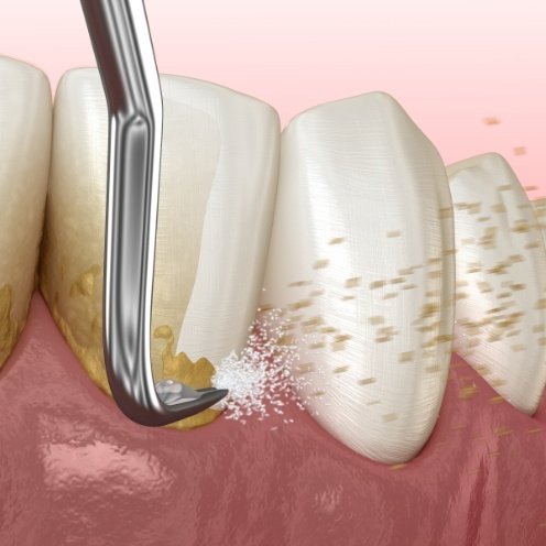 Animated dental instrument removing plaque buildup from teeth