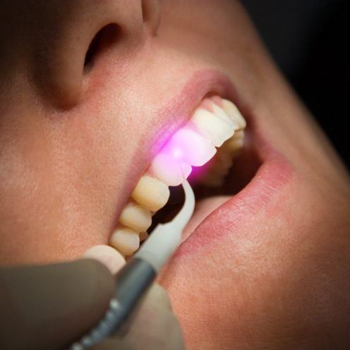 Close up of dentist using laser to treat gum disease