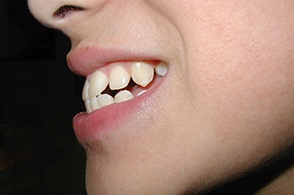 Side profile of an underbite