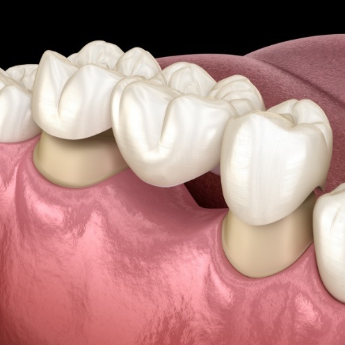 Animated dental bridge being fitted to replace a missing tooth