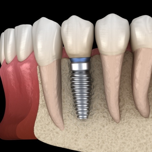 Animated dental implant with dental crown in lower jaw