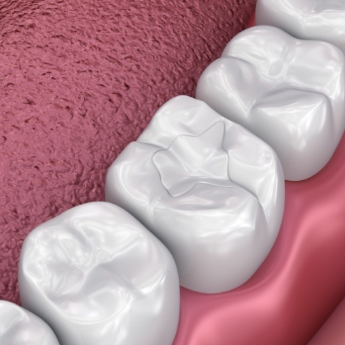 Close up of animated teeth with dental sealants