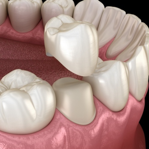 Animated dental crown being fitted over a tooth