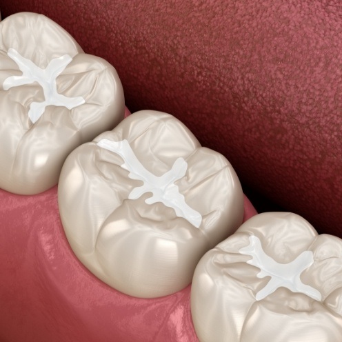 Close up of animated teeth with tooth colored fillings