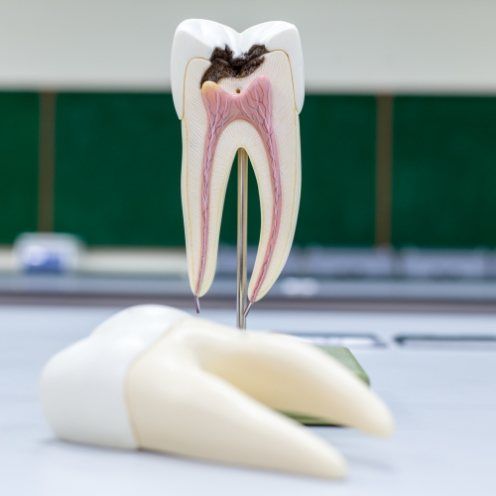 Model of damaged tooth needing root canal treatment