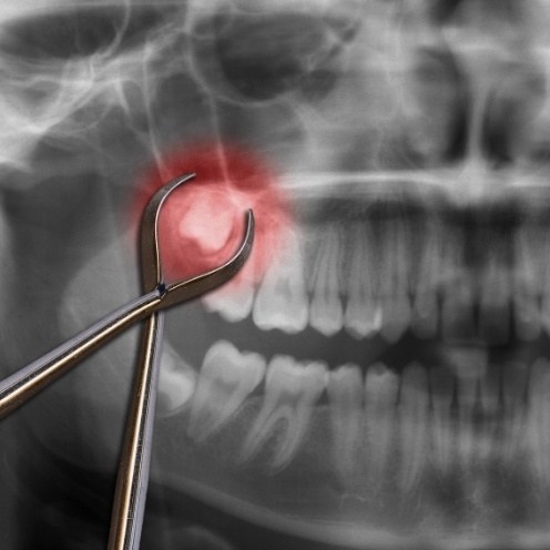 Dental forceps pointing to wisdom teeth highlighted red on dental x ray