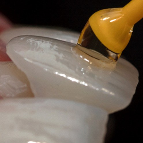 closeup of patient getting veneers